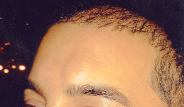 Bump on Singh’s forehead