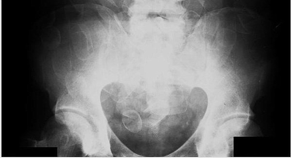  X-ray showing cocaine packets in drug mule's intestines