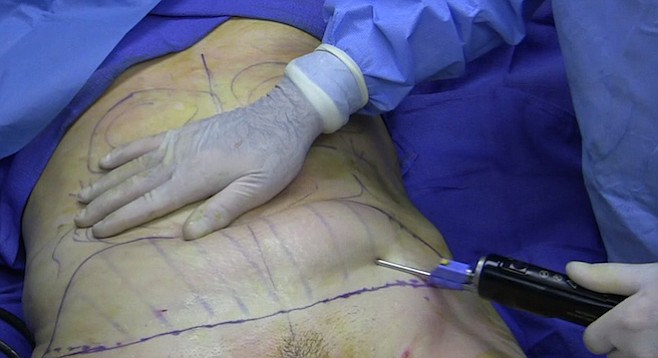 Liposuction of the belly of a 40-year-old woman