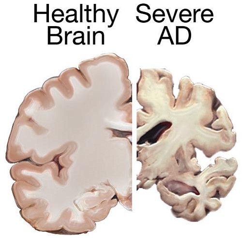 Contrast between a healthy brain and one with Alzheimer's disease