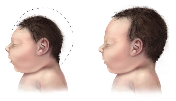 Microcephaly comparison (normal baby's head size on right)