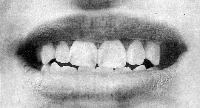 Dental fluorosis - Image by Sandy Huffaker, Jr.