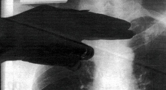 Nurse points to possible tuberculosis on chest X-ray
