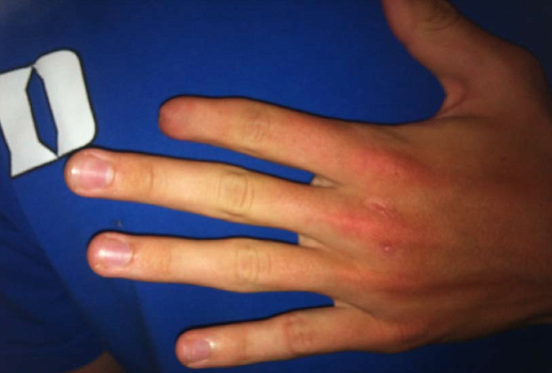 Hammond's healed finger