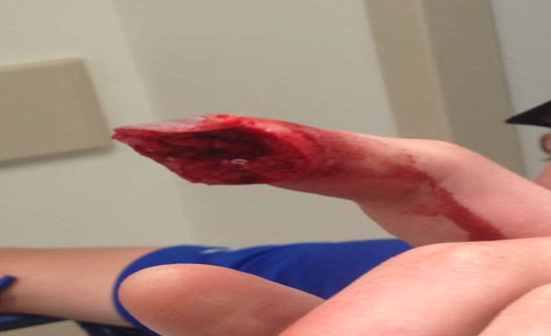 Hammond's finger soon after the accident
