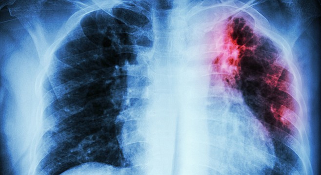  “Among clients who are diagnosed with tuberculosis in San Diego, an estimated 40 clients per year require services on both sides of the US-Mexico border.” - Image by Stockdevil/iStock/Thinkstock