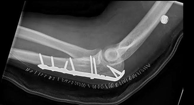 X-ray of Christian Fischer's post-surgery elbow