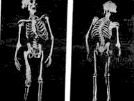 Skeletons of John Merrick, one of history’s most disfigured human beings