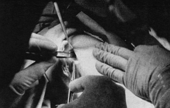 Removing bits of torn knee cartilage remains one of the commonest and most practical applications for the new surgical technique.