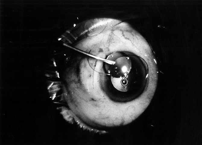 Phacoemulsification by Ronald Friedman as seen though microscope (hairlike coils are sutures)