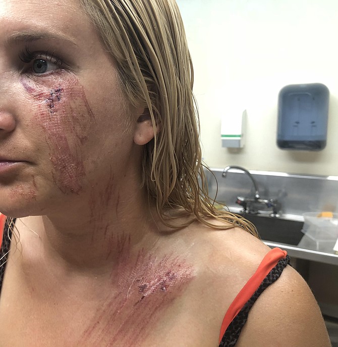 "I sustained major trauma to my face, neck and chest and had eleven stitches in my left cheek."